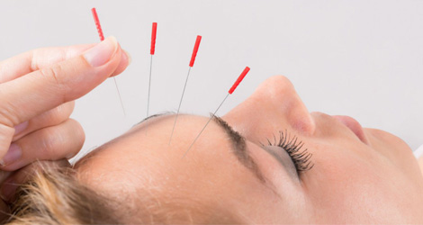 Acupuncture